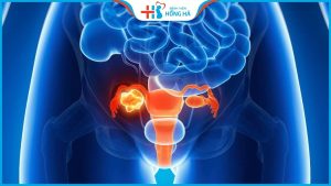 Các nguyên nhân và điều trị bệnh viêm lộ tuyến và ung thư cổ tử cung