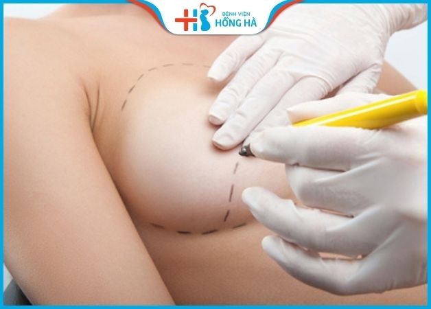 Phẫu thuật nâng ngực chảy xệ nguy hiểm nếu thực hiện tại các bệnh viện không đủ điều kiện hoạt động