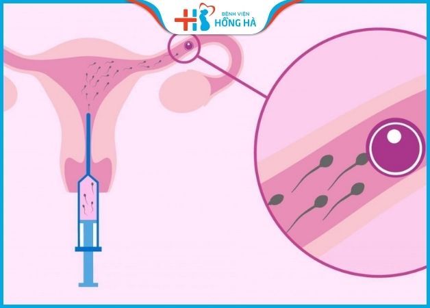 Thụ tinh nhân tạo là phương pháp bơm tinh trùng vào tử cung