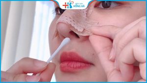 Cắt chỉ nâng mũi có đau không? Thời điểm vàng để cắt chỉ nâng mũi