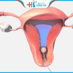 Kỹ thuật thụ tinh nhân tạo: Cần chuẩn bị điều kiện gì để thụ thai