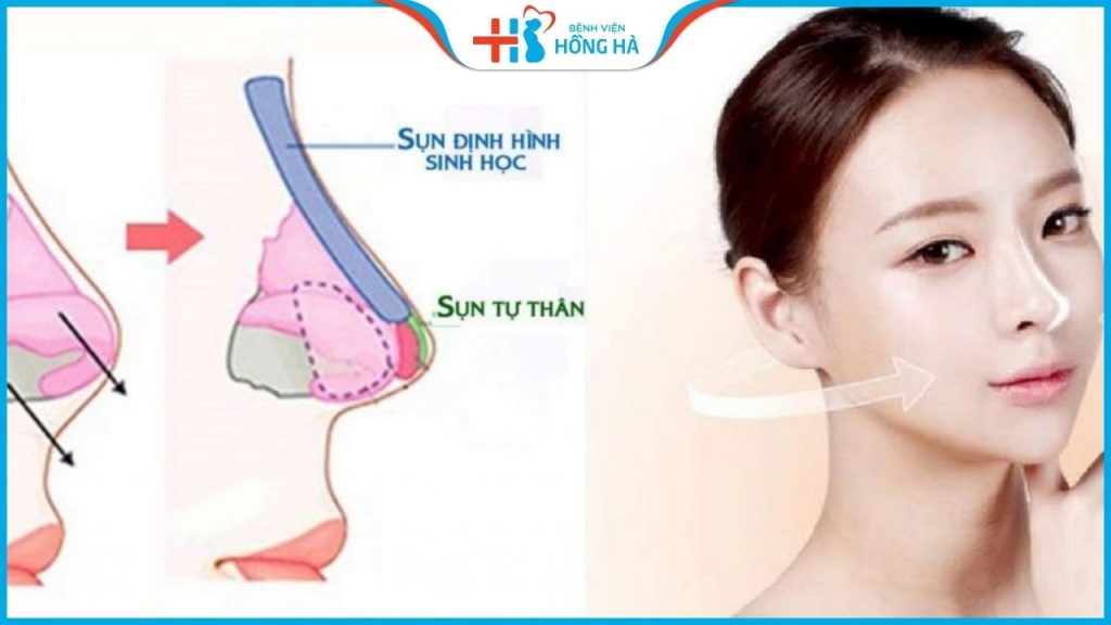 Nâng mũi bọc sụn được bao lâu? Mấy năm phải đi nâng lại?