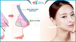 Nâng mũi bọc sụn được bao lâu? Mấy năm phải đi nâng lại?