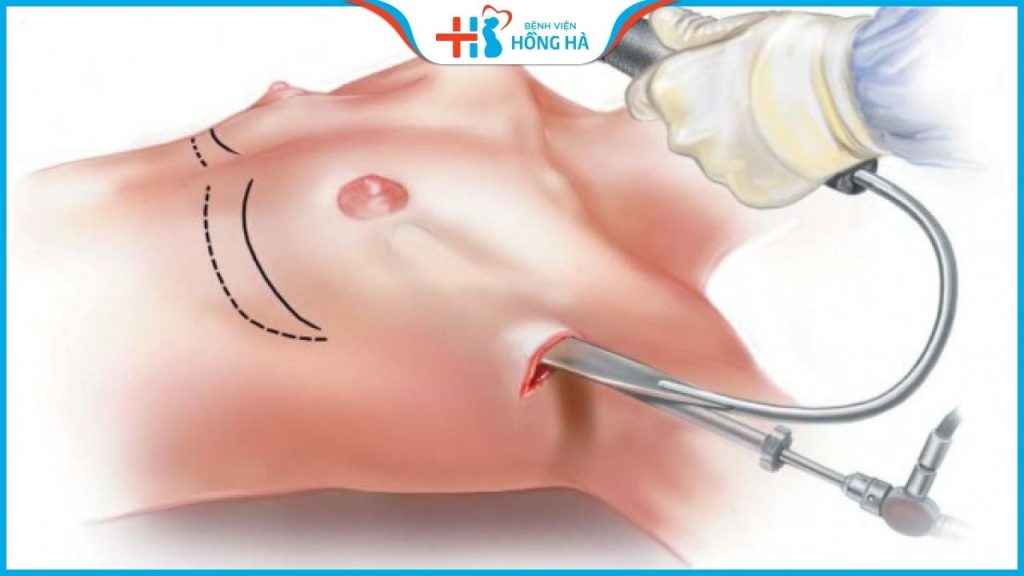 Hỏi đáp: Nâng ngực có nguy hiểm không?