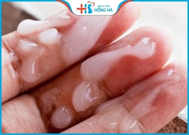 Tinh trùng vón cục có màu vàng hoặc nâu, vón giống hạt gạo