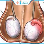 Viêm tinh hoàn nguyên nhân gây viêm da bìu hàng đầu ở trẻ