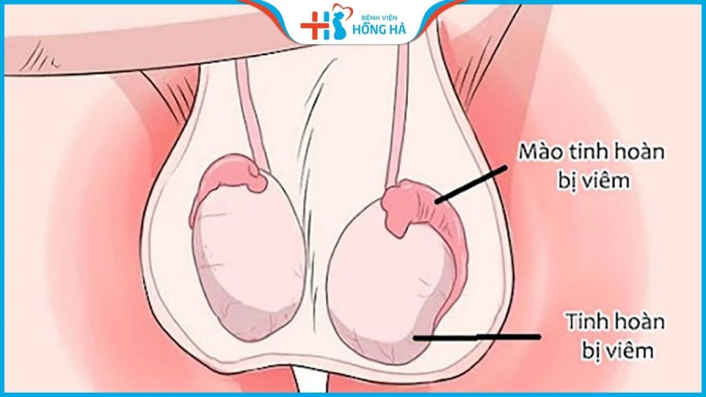 Viêm mào tinh hoàn mãn tính:  5 Nguyên nhân gây bệnh