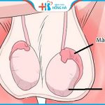 Viêm mào tinh hoàn mãn tính:  5 Nguyên nhân gây bệnh