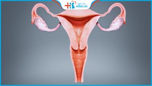 Tắc vòi trứng: Nguyên nhân chính gây vô sinh ở phụ nữ