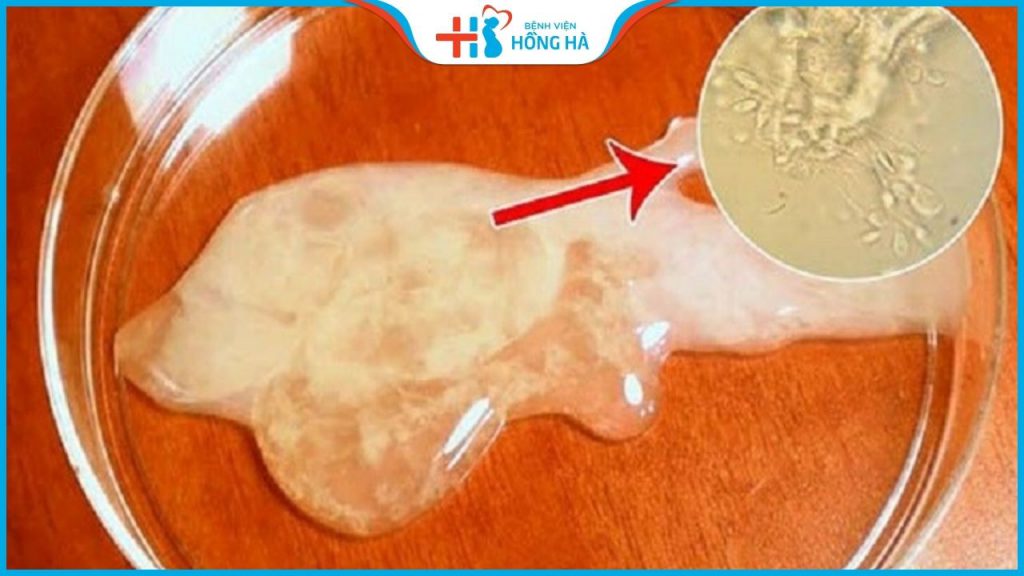 Tinh trùng ít – Nguyên nhân và cách điều trị với tỷ lệ thành công lên đến 50%