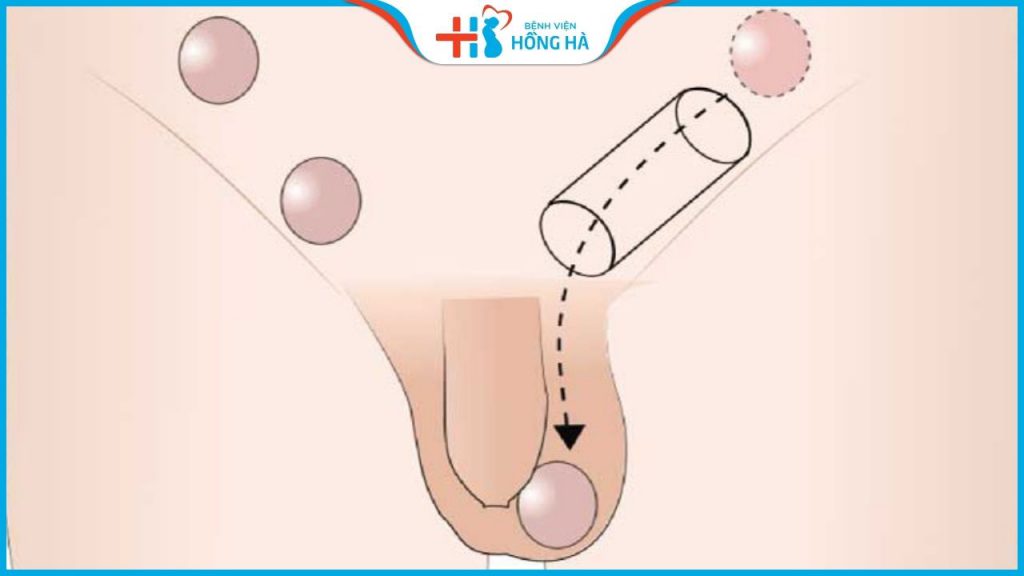 Tinh hoàn ẩn ở nam giới: Triệu chứng, nguyên nhân và biến chứng