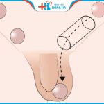 Tinh hoàn ẩn ở nam giới: Triệu chứng, nguyên nhân và biến chứng