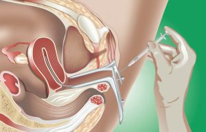 Cải thiện khả năng thụ thai: Phương pháp bơm tinh trùng vào tử cung IUI