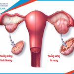 Cách phòng ngừa và điều trị đa nang buồng trứng hiệu quả