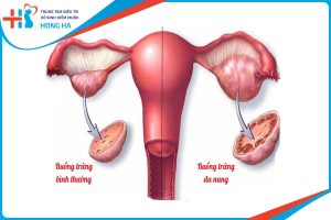 Cách phòng ngừa và điều trị đa nang buồng trứng hiệu quả