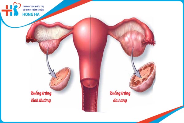Cách phòng ngừa và điều trị đa nang buồng trứng hiệu quả