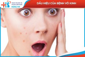 Vô kinh ở phụ nữ: Nguyên nhân và cách điều trị hiệu quả nhất