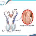 Tác động giãn tĩnh mạch thừng tinh đến sinh sản và điều trị hiệu quả