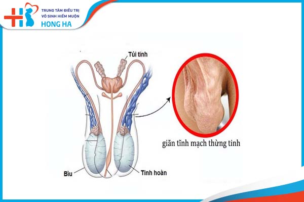 Tác động giãn tĩnh mạch thừng tinh đến sinh sản và điều trị hiệu quả