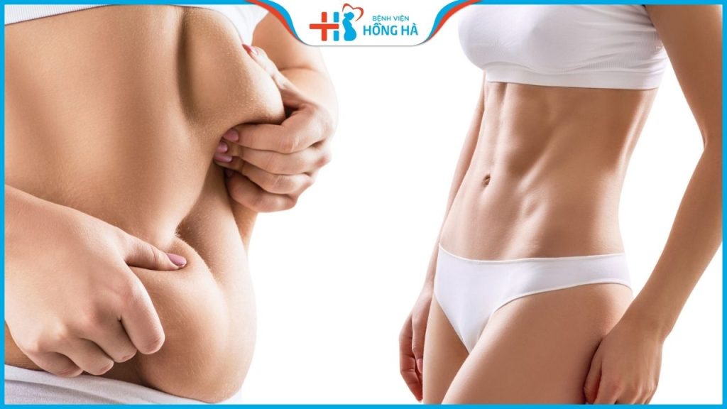 Hút mỡ an có toàn không? Quy trình hút mỡ lấy lại eo thon