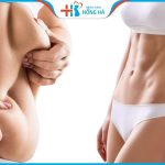 Hút mỡ an có toàn không? Quy trình hút mỡ lấy lại eo thon