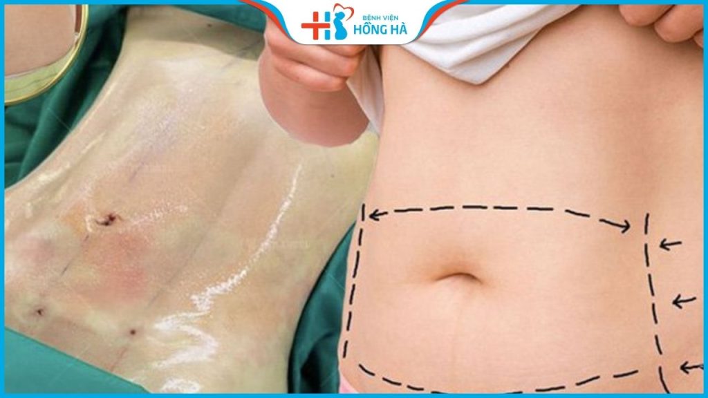 Hút mỡ bụng có nguy hiểm không, để lại di chứng không?