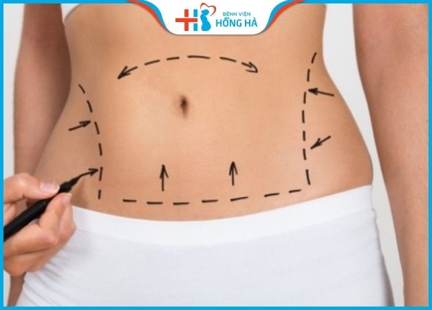 Hút mỡ bụng là phương pháp phẫu thuật thẩm mỹ giúp loại bỏ mỡ thừa