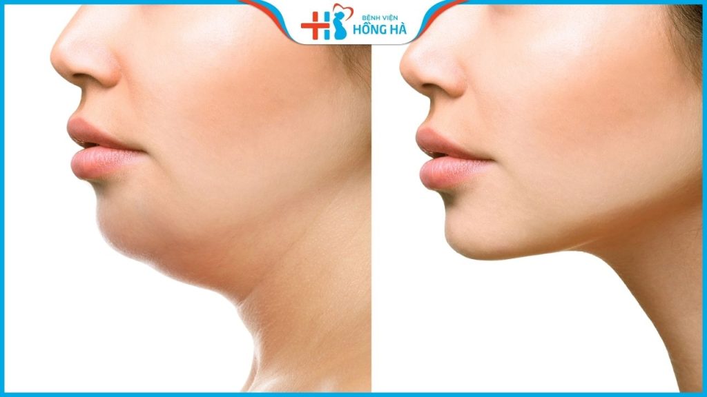 Hút mỡ cằm: Quy trình thực hiện, Review khách hàng sau khi hút mỡ cằm