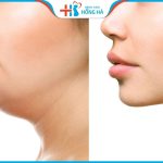 Hút mỡ cằm: Quy trình thực hiện, Review khách hàng sau khi hút mỡ cằm