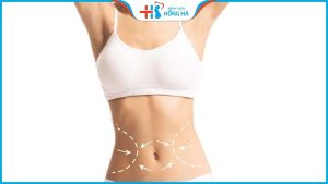 Hút mỡ có đau không? 5 Cách giảm đau cực nhanh sau hút mỡ