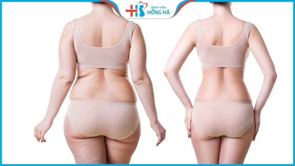 Hút mỡ toàn thân giá bao nhiêu hợp lý? Báo giá không phát sinh