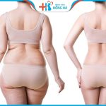 Hút mỡ toàn thân giá bao nhiêu hợp lý? Báo giá không phát sinh