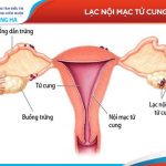 Lạc nội mạc tử cung: Nguyên nhân, triệu chứng và điều trị