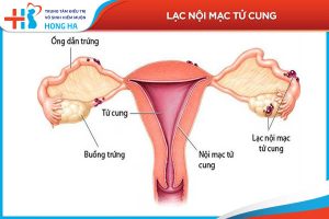 Lạc nội mạc tử cung: Nguyên nhân, triệu chứng và điều trị