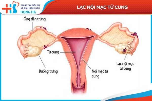 Lạc nội mạc tử cung: Nguyên nhân, triệu chứng và điều trị