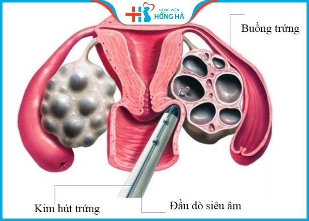 Mô phỏng quá trình chọc hút trứng lấy trứng để thụ tinh nhân tạo có đau không.