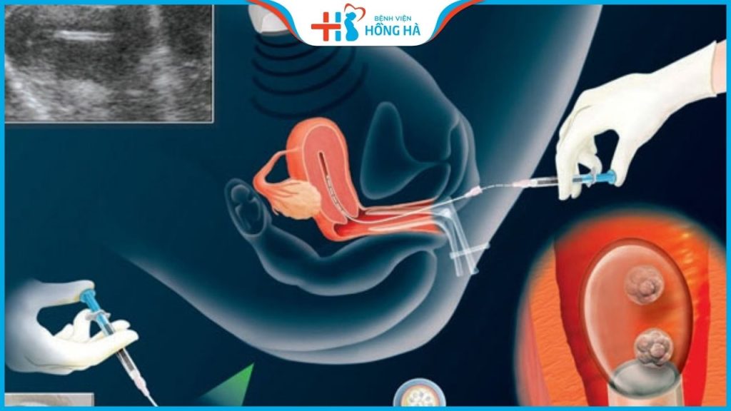 Lấy trứng để thụ tinh nhân tạo: Cách giảm đau trong quá trình lấy trứng