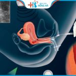 Lấy trứng để thụ tinh nhân tạo: Cách giảm đau trong quá trình lấy trứng