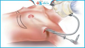 Nâng ngực cho người chuyển giới: Lợi ích, khó khăn, địa chỉ uy tín