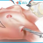 Nâng ngực đường nách tốt không? Phù hợp với ai? 