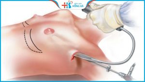 Nâng ngực đường nách tốt không? Phù hợp với ai?