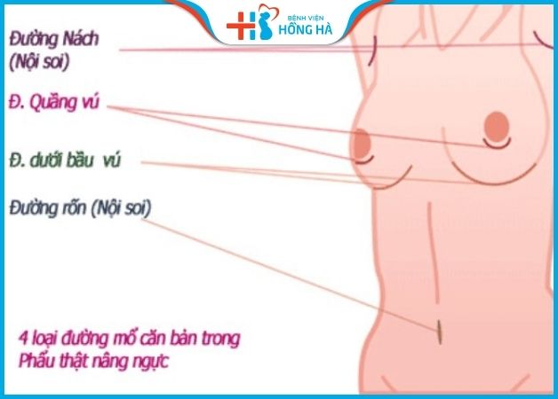 4 đường mổ nâng ngực phổ biến trong nâng ngực thẩm mỹ