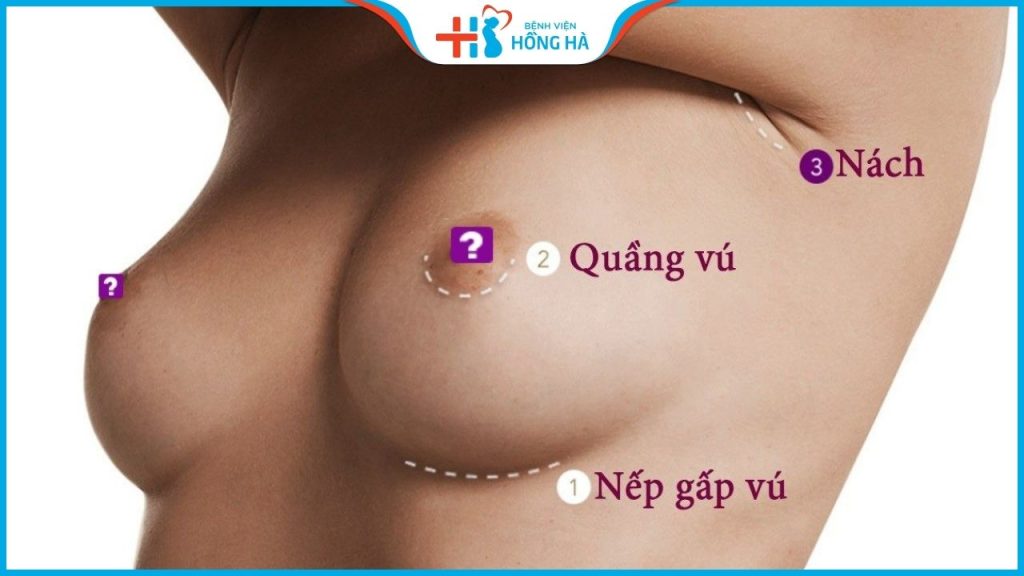 Nâng ngực đường nào tốt nhất – So sánh ưu nhược điểm các đường mổ