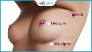 Nâng ngực đường nào tốt nhất – So sánh ưu nhược điểm các đường mổ
