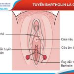 Nang tuyến Bartholin: Triệu chứng, nguyên nhân và điều trị hiệu quả