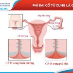 Phì đại cổ tử cung: Nguyên nhân, triệu chứng và phương pháp điều trị