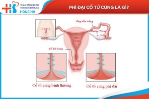 Phì đại cổ tử cung: Nguyên nhân, triệu chứng và phương pháp điều trị