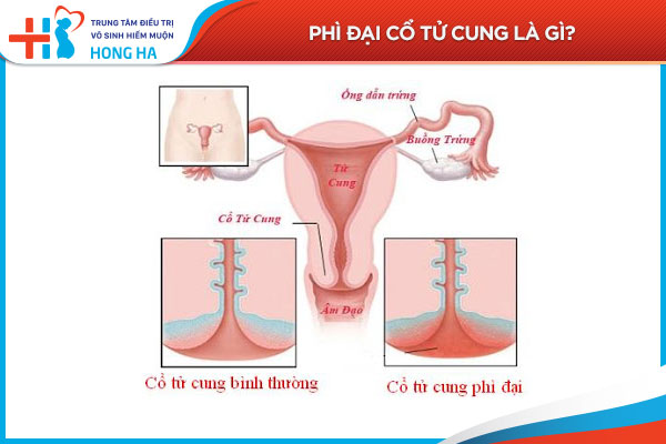 Làm thế nào để phòng ngừa phì đại cổ tử cung?
