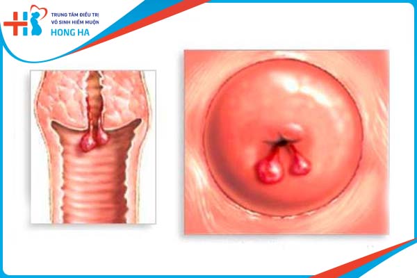 Polyp cổ tử cung: Nguyên nhân, triệu chứng và cách điều trị hiệu quả