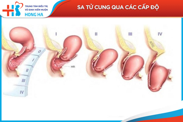 Điều trị sa tử cung: Phương pháp hiệu quả để giảm thiểu rủi ro cho thai kỳ
